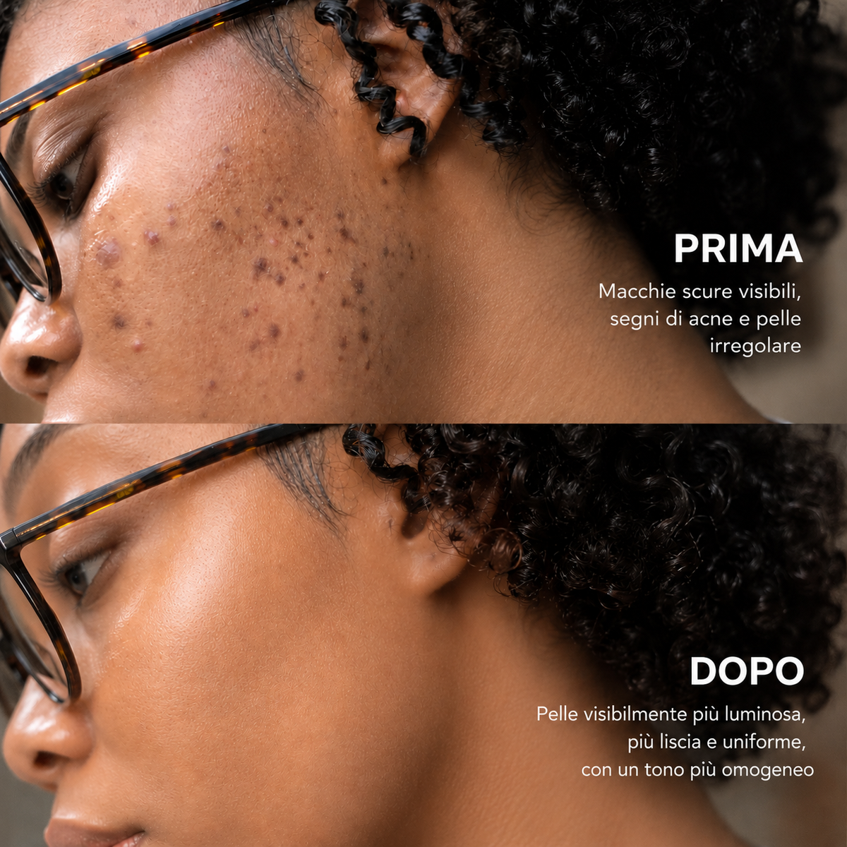 Crema illuminante con acido Tranexamico